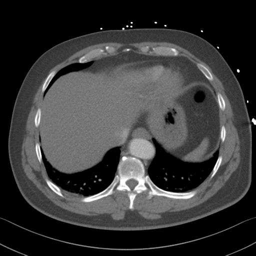 File:Aortic dissection (Radiopaedia 50763-56234 A 60).png