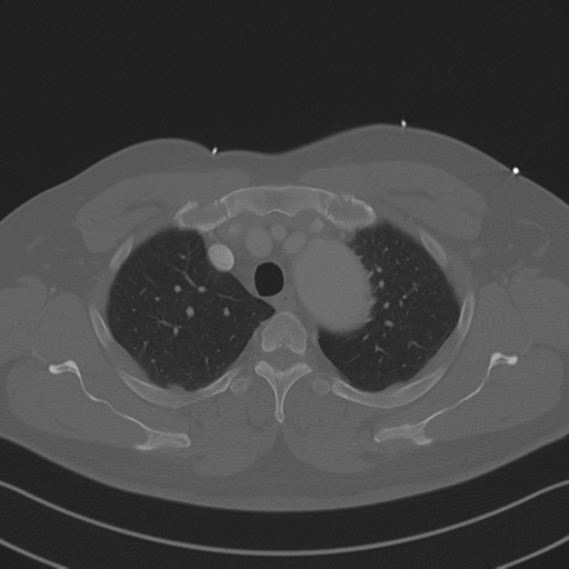 File:Aortic dissection (Radiopaedia 50763-56234 Axial bone window 28).png