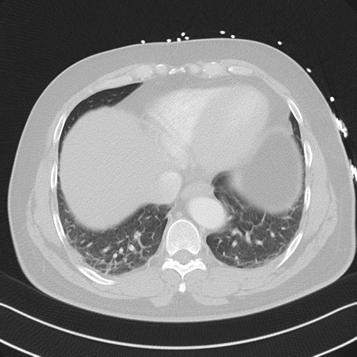 File:Aortic dissection (Radiopaedia 50763-56234 Axial lung window 49).png