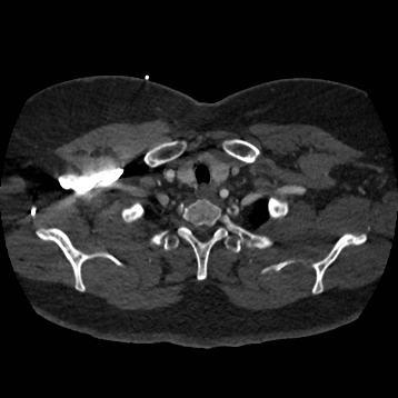 Aortic dissection (Radiopaedia 57969-64959 A 37).jpg