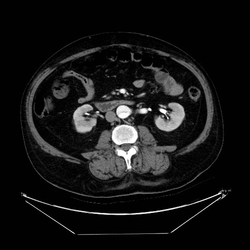 Aortic dissection (Radiopaedia 62562-71000 A 70).jpg