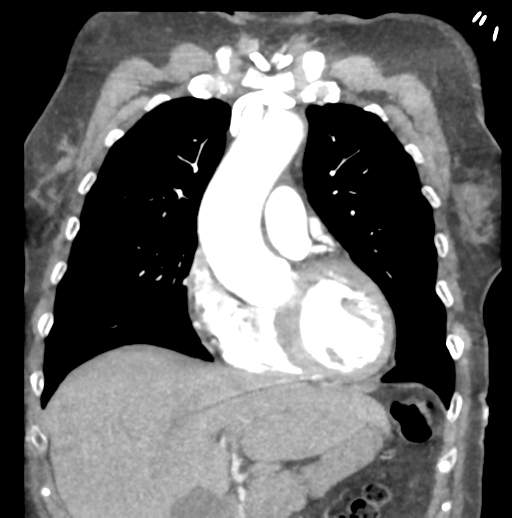 File:Aortic dissection - Stanford type B (Radiopaedia 50171-55512 B 29).png