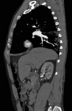 File:Aortic dissection - Stanford type B (Radiopaedia 73648-84437 C 102).jpg