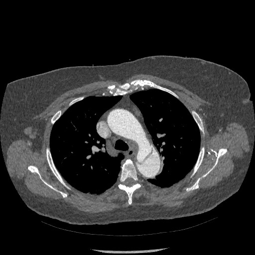 Aortic dissection - Stanford type B (Radiopaedia 88281-104910 A 22).jpg