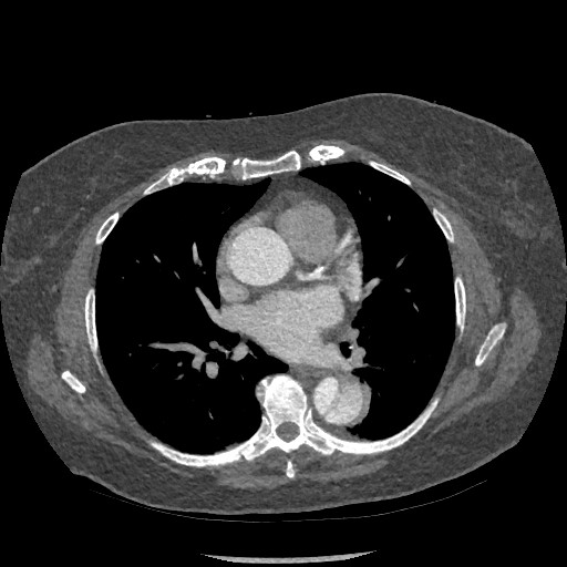 File:Aortic dissection - Stanford type B (Radiopaedia 88281-104910 A 45).jpg