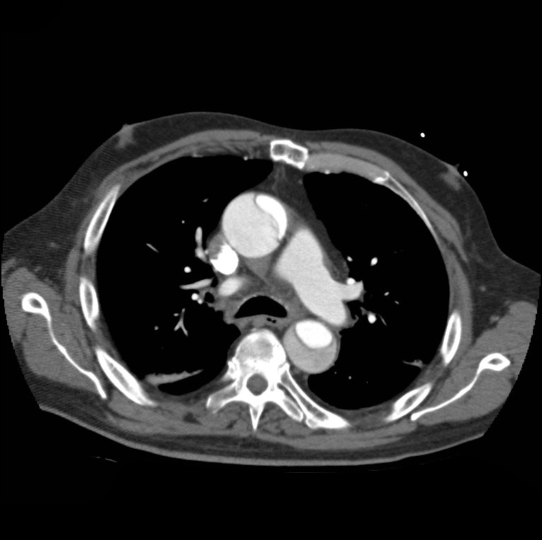 Aortic dissection with rupture into pericardium (Radiopaedia 12384-12647 A 22).jpg