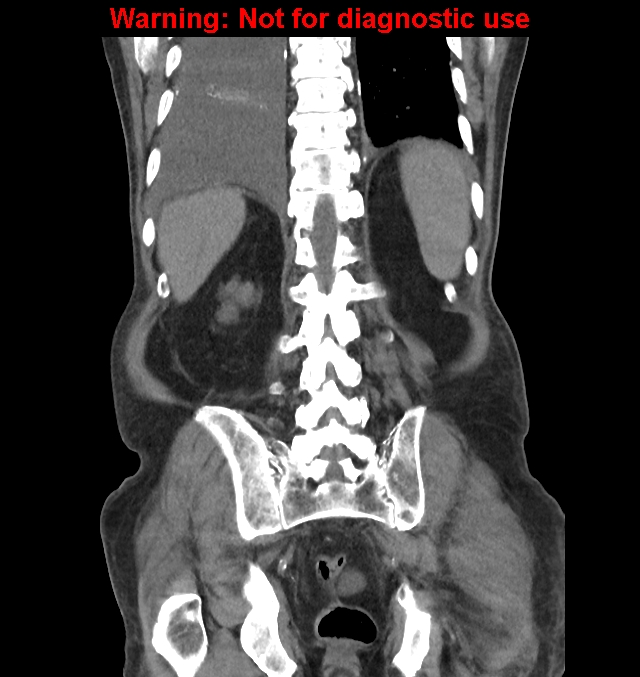 Aortic graft infection (Radiopaedia 44979-48907 non-contrast 40).jpg