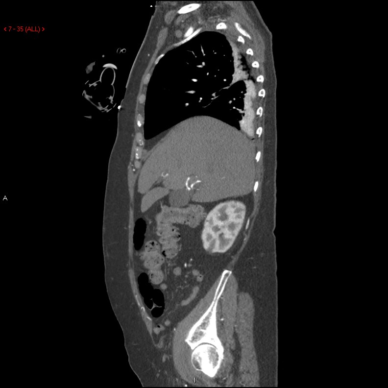 Aortic intramural hematoma (Radiopaedia 27746-28001 C 4).jpg
