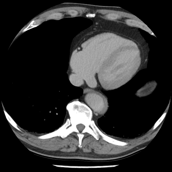 File:Aortic intramural hematoma (type B) (Radiopaedia 79323-92387 Axial C+ delayed 41).jpg