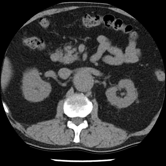 Aortic intramural hematoma (type B) (Radiopaedia 79323-92387 Axial non-contrast 64).jpg