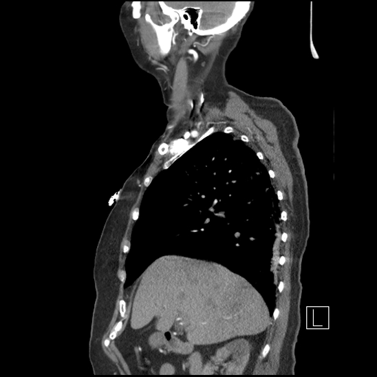 Aortic intramural hematoma with dissection and intramural blood pool (Radiopaedia 77373-89491 D 26).jpg