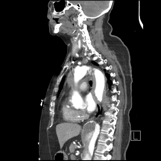 Aortic intramural hematoma with dissection and intramural blood pool (Radiopaedia 77373-89491 D 48).jpg