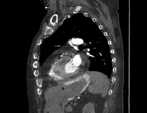 Aortoesophageal fistula with endovascular repair (Radiopaedia 73781-84592 Sagittal C+ CTPA 129).jpg