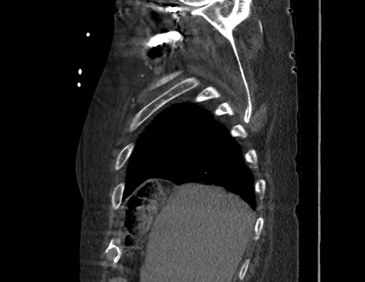 Aortoesophageal fistula with endovascular repair (Radiopaedia 73781-84592 Sagittal C+ CTPA 21).jpg
