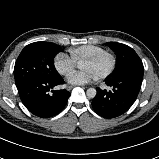 Apical lung mass mimic - neurogenic tumor (Radiopaedia 59918-67521 A 49).jpg