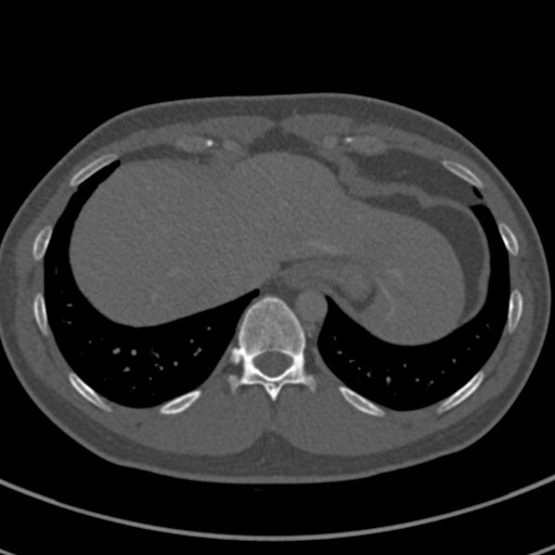 Apical lung mass mimic - neurogenic tumor (Radiopaedia 59918-67521 Axial bone window 70).jpg