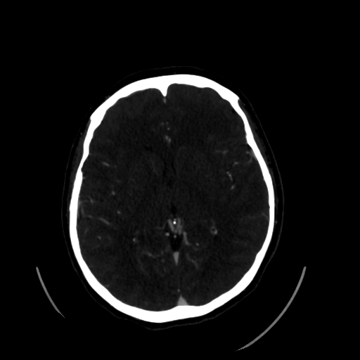 File:Aplasia of the internal carotid artery (Radiopaedia 61082-68960 A 36).jpg