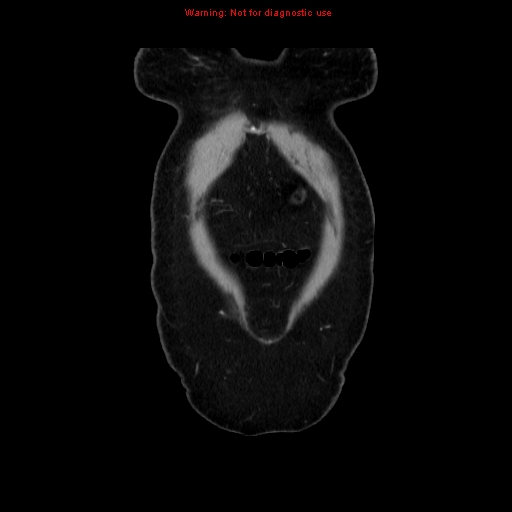 Appendiceal mucinous cystadenoma (Radiopaedia 8263-9111 B 5).jpg