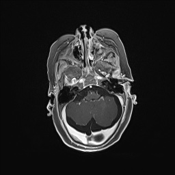 Aqueductal stenosis (Radiopaedia 73974-84802 Axial T1 C+ 50).jpg