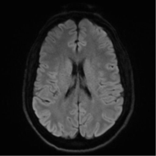 Arachnoid cyst - cerebellopontine angle (Radiopaedia 59689-67083 Axial DWI 58).png
