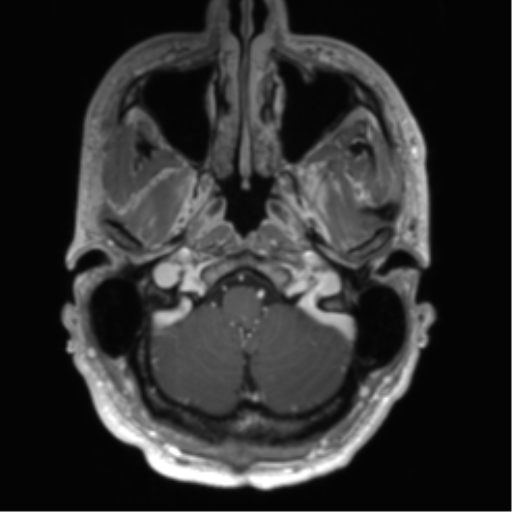 Arachnoid cyst with subdural hematoma (Radiopaedia 85892-101743 Axial T1 C+ 15).png