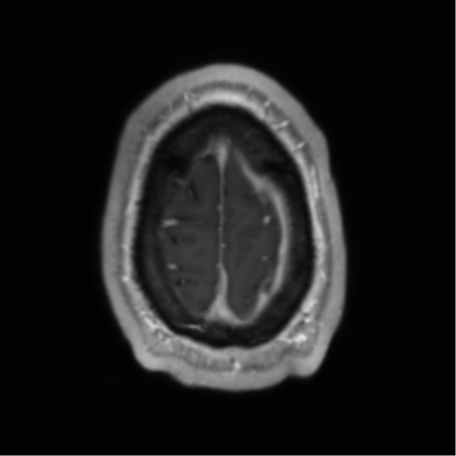 Arachnoid cyst with subdural hematoma (Radiopaedia 85892-101743 Axial T1 C+ 76).png