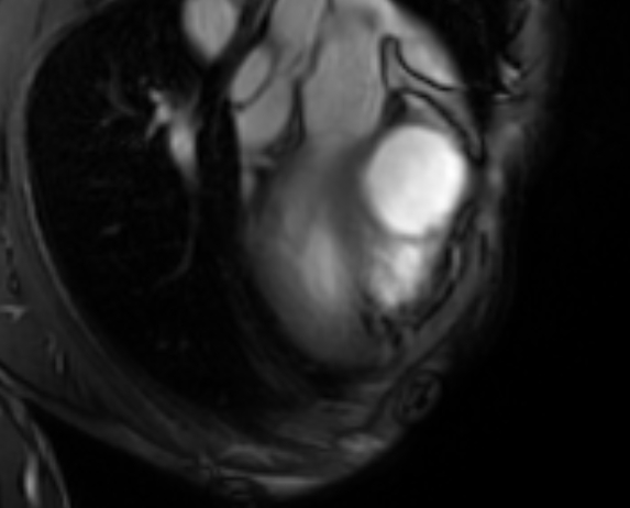 File:Arrhythmogenic right ventricular cardiomyopathy (Radiopaedia 69564-79464 4ch cine 7).jpg