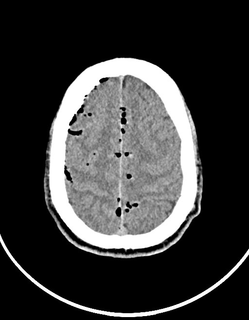 Arrow injury to the brain (Radiopaedia 72101-82607 Axial non-contrast 85).jpg