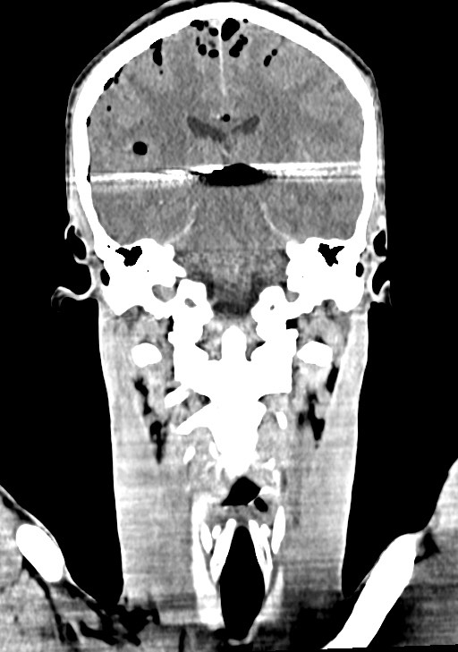 Arrow injury to the brain (Radiopaedia 72101-82607 Coronal non-contrast 45).jpg