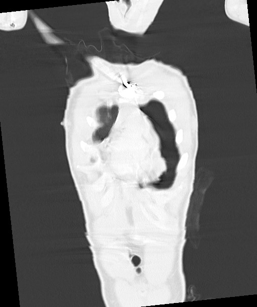 Arrow injury to the chest (Radiopaedia 85367-100975 Coronal lung window 42).jpg