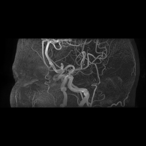 File:Arteriovenous malformation (Radiopaedia 71628-81999 Axial MRA 5).jpg