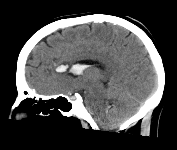 File:Arteriovenous malformation (cerebral) (Radiopaedia 40070-42579 B 18).png
