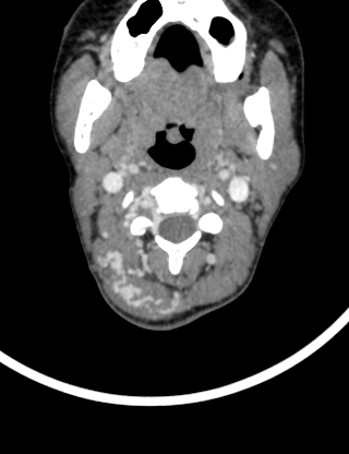 Arteriovenous malformation of the neck (Radiopaedia 53935-60062 B 13).jpg