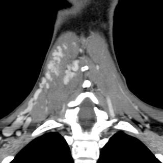 Arteriovenous malformation of the neck (Radiopaedia 53935-60062 D 36).jpg