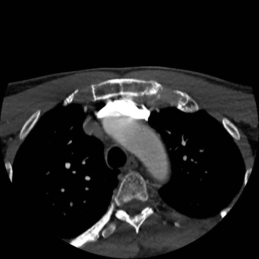 Artery of Percheron infarct (Radiopaedia 48088-52894 A 6).jpg