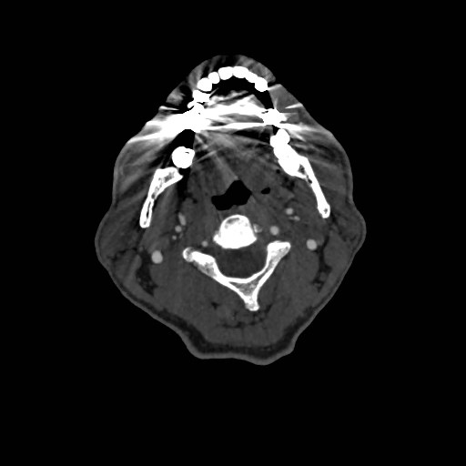 Artery of Percheron infarct (Radiopaedia 48088-52894 A 85).jpg