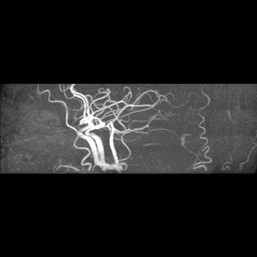 Artery of Percheron infarction (Radiopaedia 27975-28230 3D TOF 3).jpg