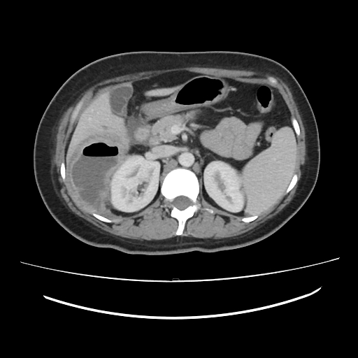 Ascending retrocecal appendicitis with liver abscesses (Radiopaedia 60066-67615 B 33).jpg