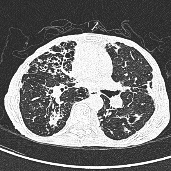 Aspergilloma- with Monod sign (Radiopaedia 44737-48532 Axial lung window 133).jpg