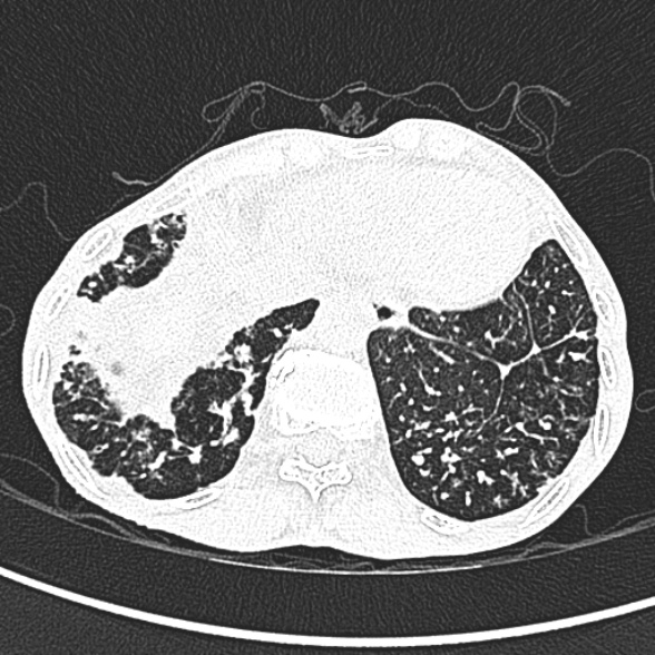 Aspergilloma- with Monod sign (Radiopaedia 44737-48532 Axial lung window 254).jpg