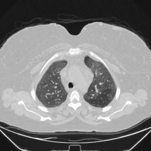 Aspergilloma (Radiopaedia 39611-41932 Axial lung window 31).jpg