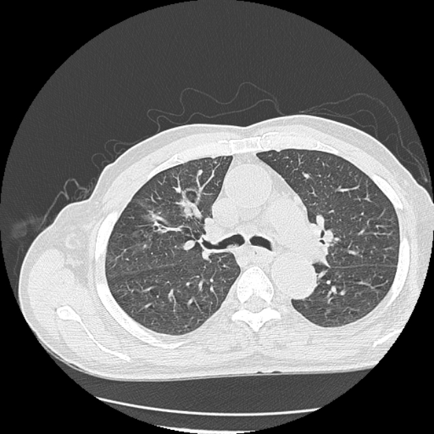 Aspergilloma (Radiopaedia 44592-48327 Axial lung window 31).jpg