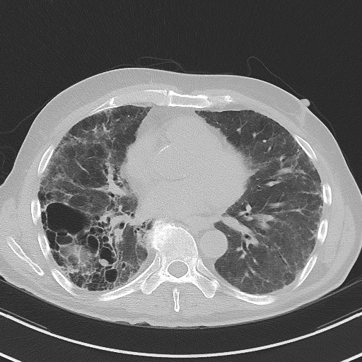Aspergilloma on background pulmonary fibrosis (Radiopaedia 60942-68757 A 34).jpg