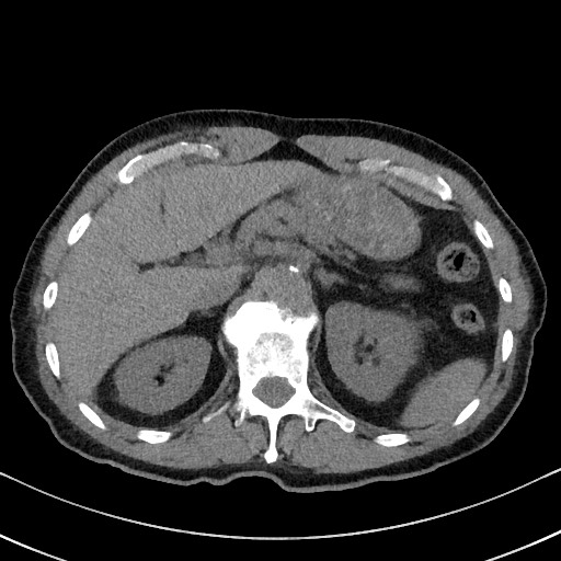 File:Aspergilloma on background pulmonary fibrosis (Radiopaedia 60942-68757 Axial non-contrast 61).jpg