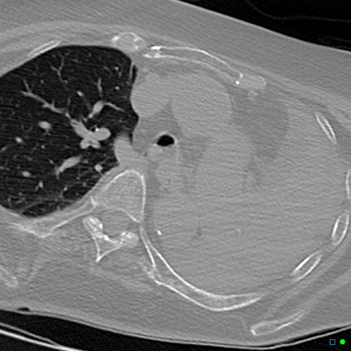 File:Aspirated food bolus obstruction of left main bronchus (Radiopaedia 29432-29904 Axial non-contrast 9).jpg