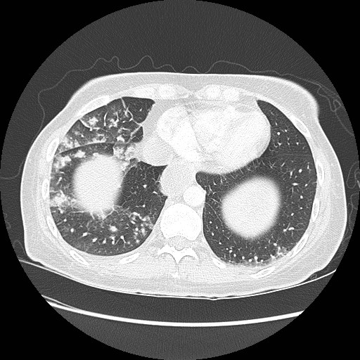Aspiration pneumonia secondary to laparoscopic banding (Radiopaedia 18345-18183 lung window 87).jpg