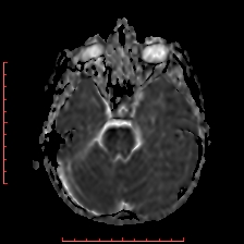 Astroblastoma (Radiopaedia 74287-85162 Axial ADC 17).jpg