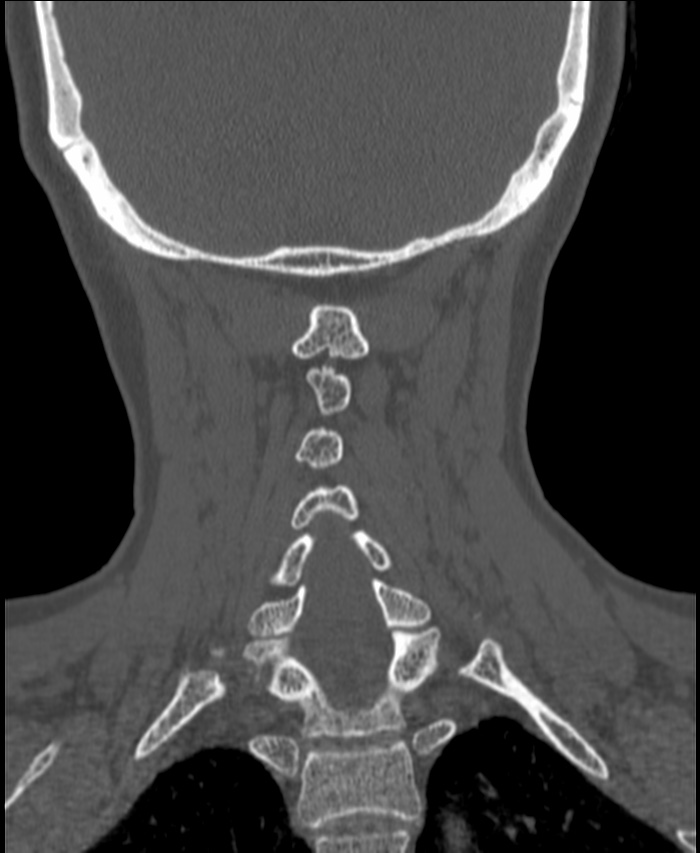 Atlanto-occipital assimilation with basilar invagination (Radiopaedia 70122-80188 Coronal bone window 169).jpg