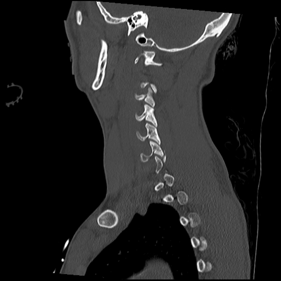 Atlanto-occipital dissociation (Traynelis type 1), C2 teardrop fracture, C6-7 facet joint dislocation (Radiopaedia 87655-104061 Sagittal bone window 50).jpg