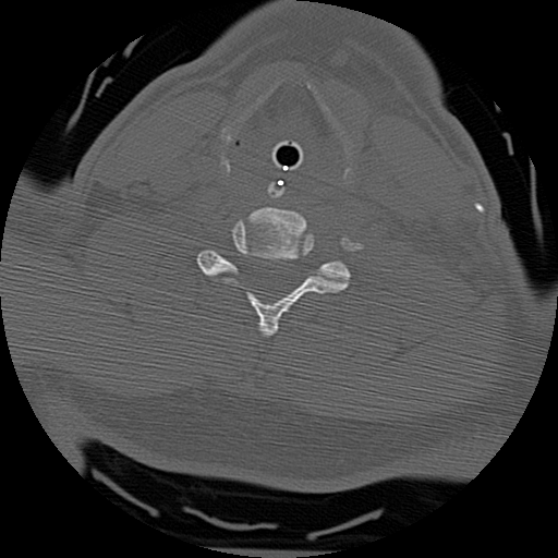 Atlanto-occipital dissociation injury (Radiopaedia 29274-29698 Axial bone window 51).png